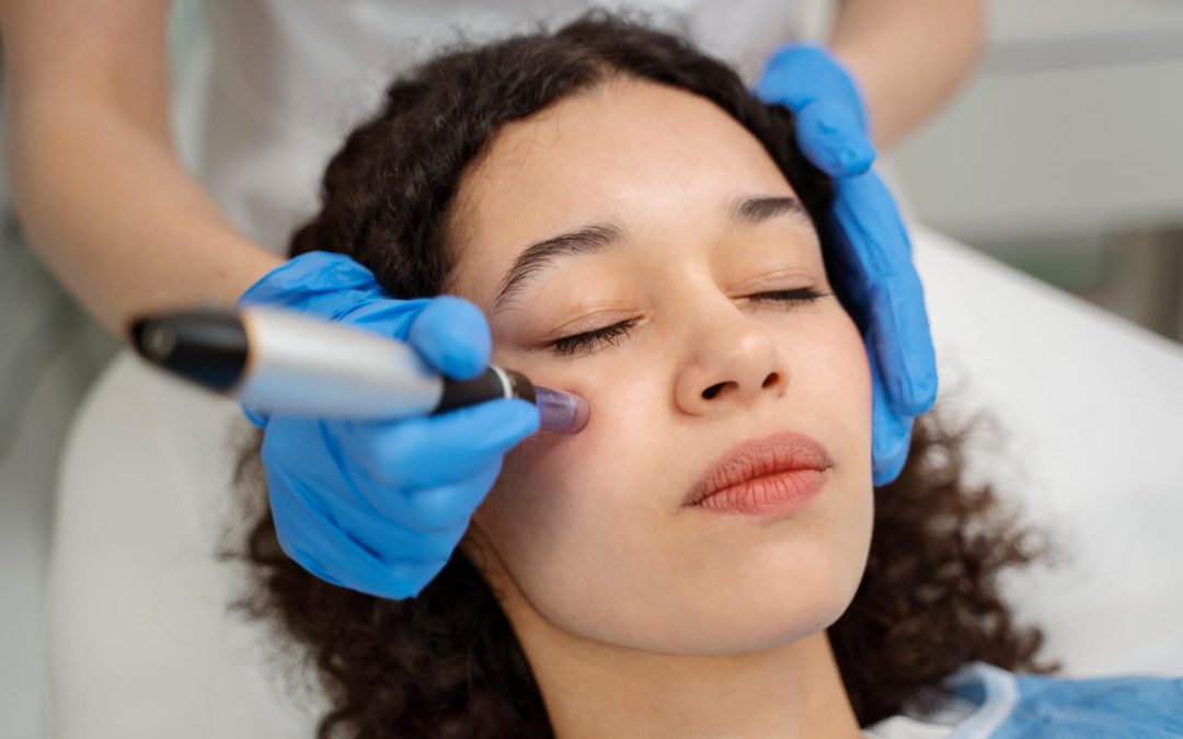 How Many Microneedling Sessions Do You Need for Acne Scars?